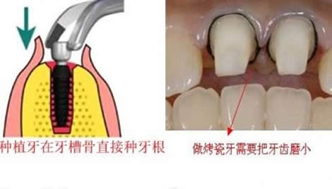 日本为什么禁止种植牙：日本禁止种植牙是真的吗